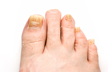 fungus toenails, fungal toenail, toenail fungus treatment in Stevens Point, WI 54481 and Waupaca, WI 54981 area